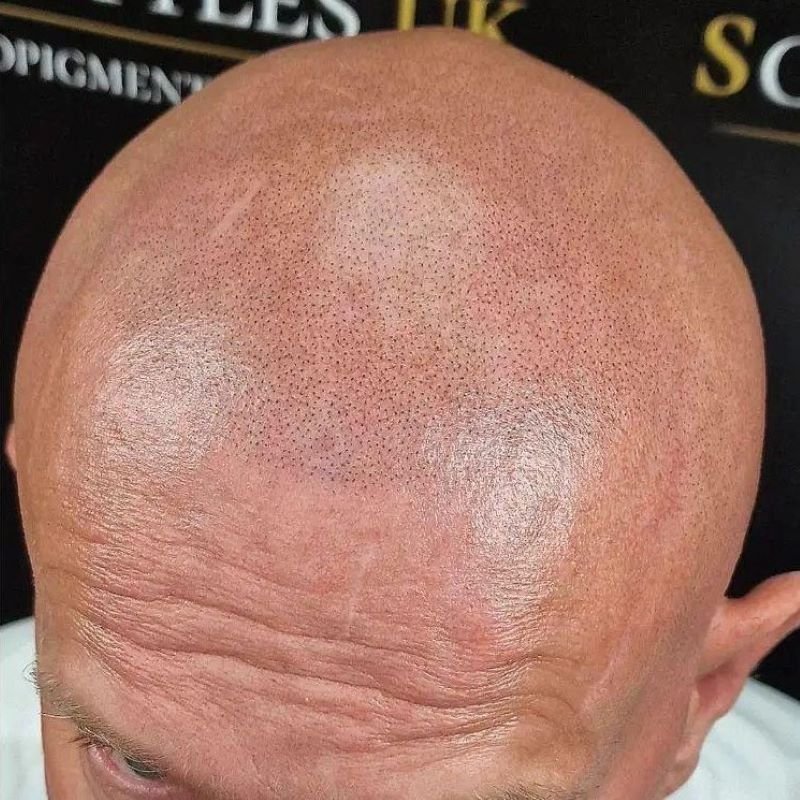 man with scalp micropigmentation wirral