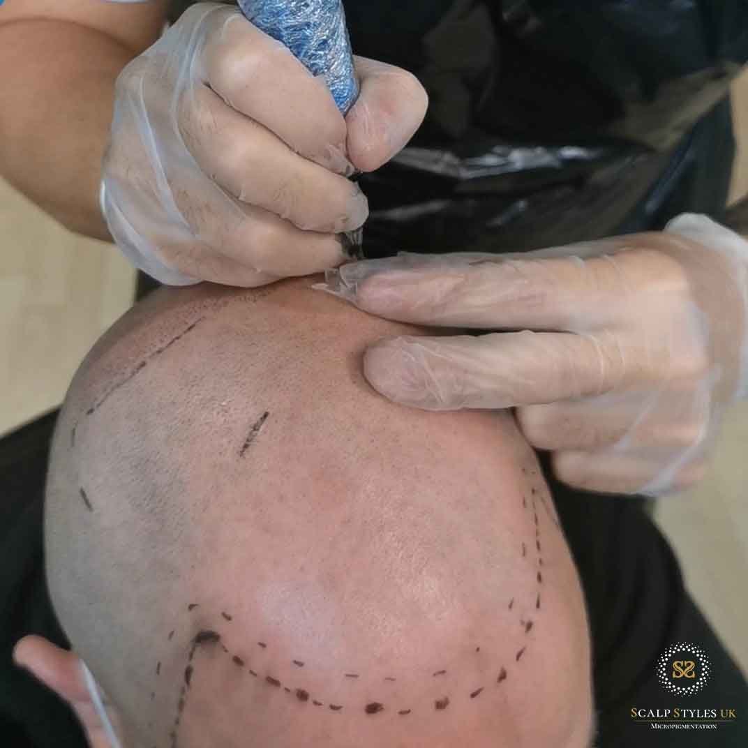 Carl performing hair tattoo (scalp micropigmentation) at Scalp Styles UK clinic in Chester