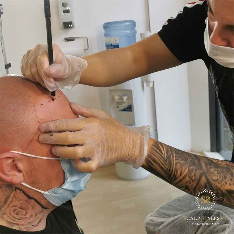 Scalp Micropigmentation initial stage