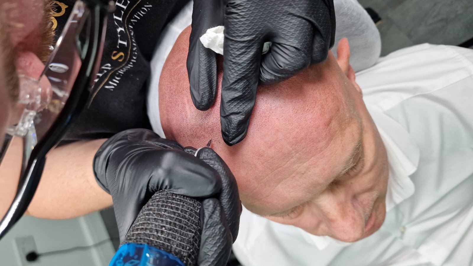 hairline 7 stages of mpb - Scalp Micropigmentation procedure