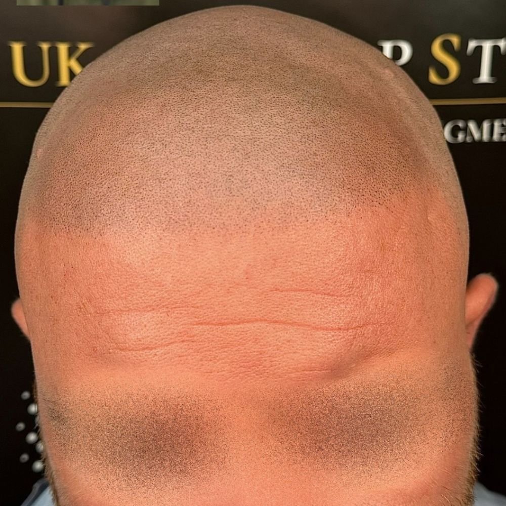 After Scalp Micropigmentation Wirral Treatment