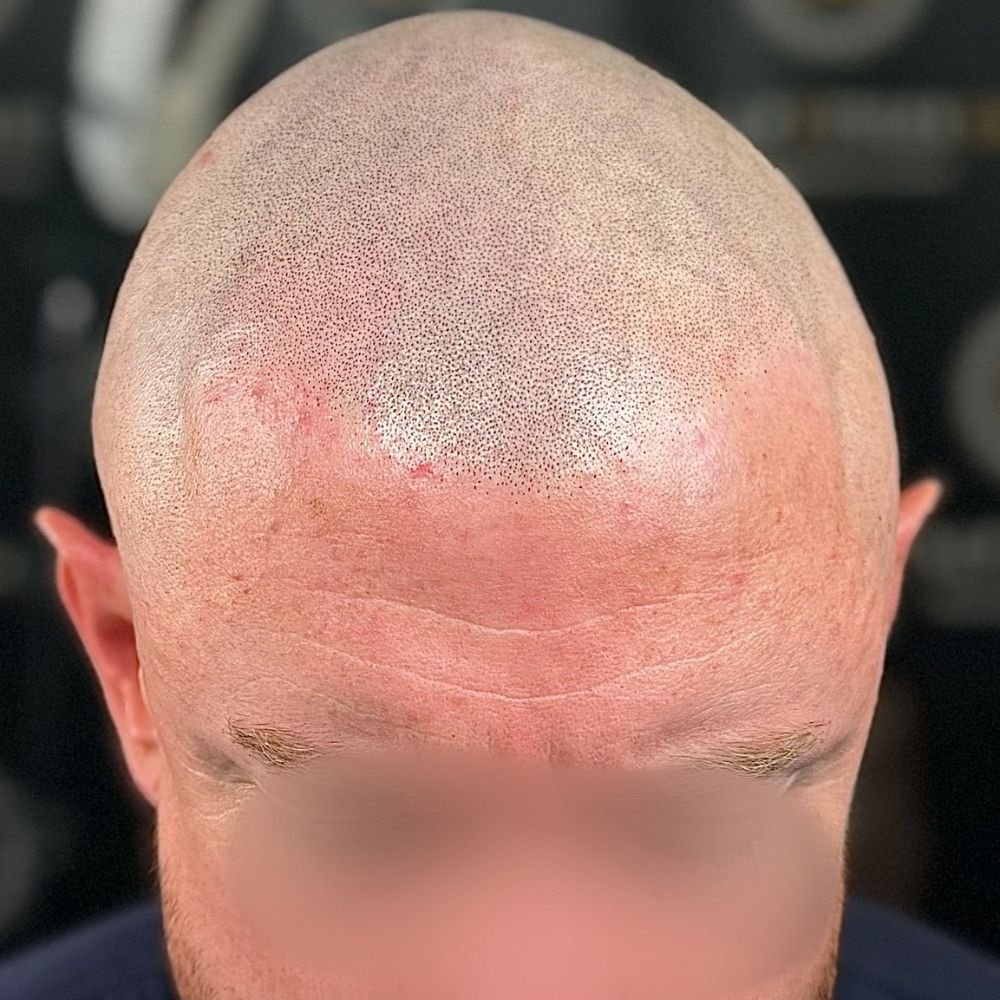 smp after scalp micropigmentation treatment