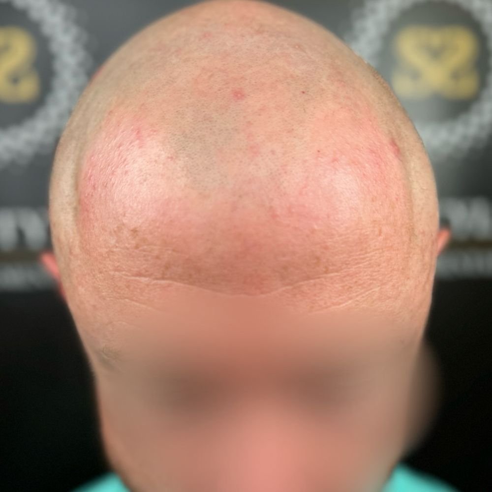 smp before scalp micropigmentation treatment